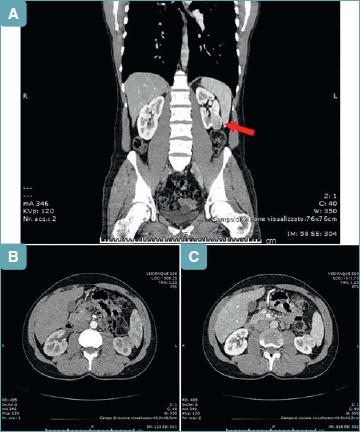 Case report of a combined oncocytoma and type 1 papillary renal cell ...