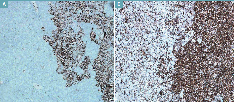 Case report of a combined oncocytoma and type 1 papillary renal cell ...