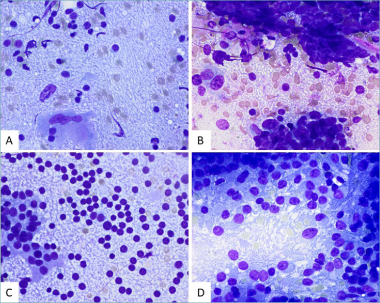 A comprehensive review of the “tigroid” background cytological concept ...