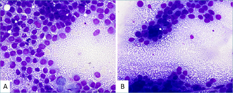 A comprehensive review of the “tigroid” background cytological concept ...